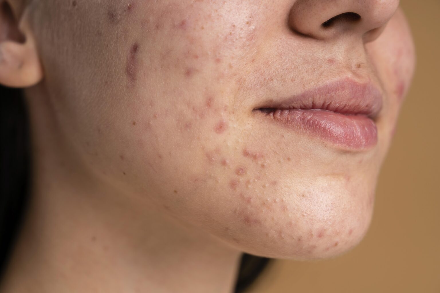 Blackheads